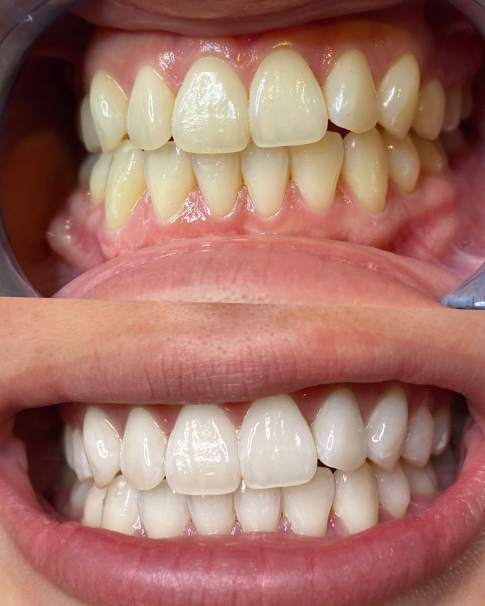 teeth whitening